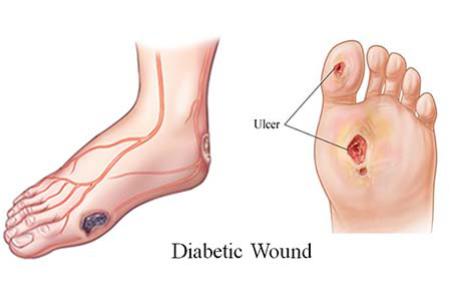 แผลเบาหวาน (DIABETIC FOOT) และการดูแลเท้ารักษาเท้า